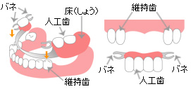 一般的な部分入れ歯